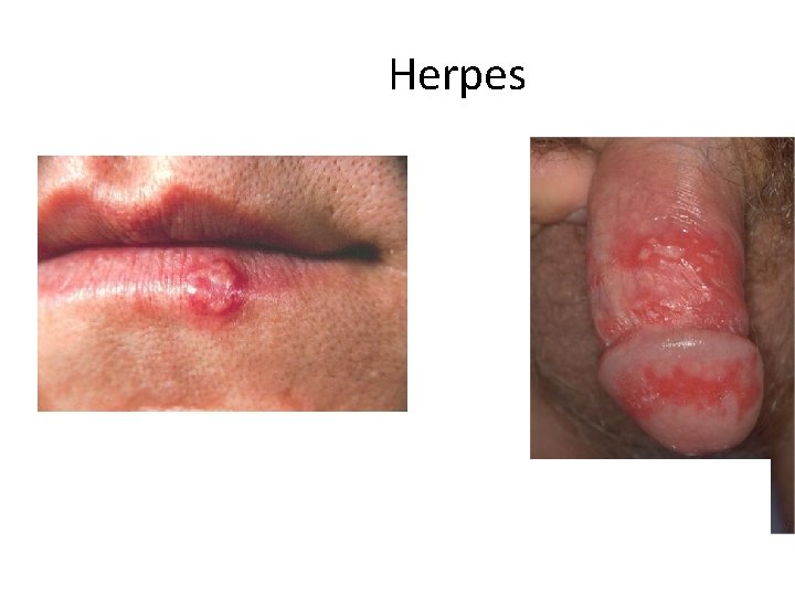 Herpes 