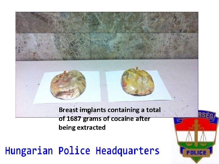 Breast implants containing a total of 1687 grams of cocaine after being extracted 