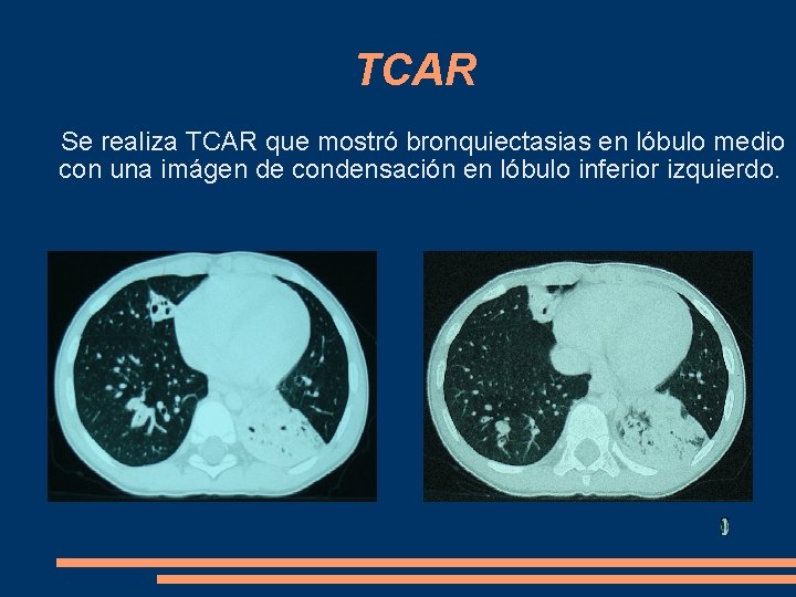 TCAR Se realiza TCAR que mostró bronquiectasias en lóbulo medio con una imágen de