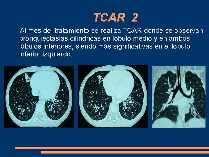 TCAR 2 Al mes del tratamiento se realiza TCAR donde se observan bronquiectasias cilíndricas