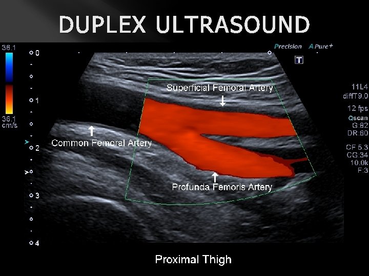 DUPLEX ULTRASOUND 