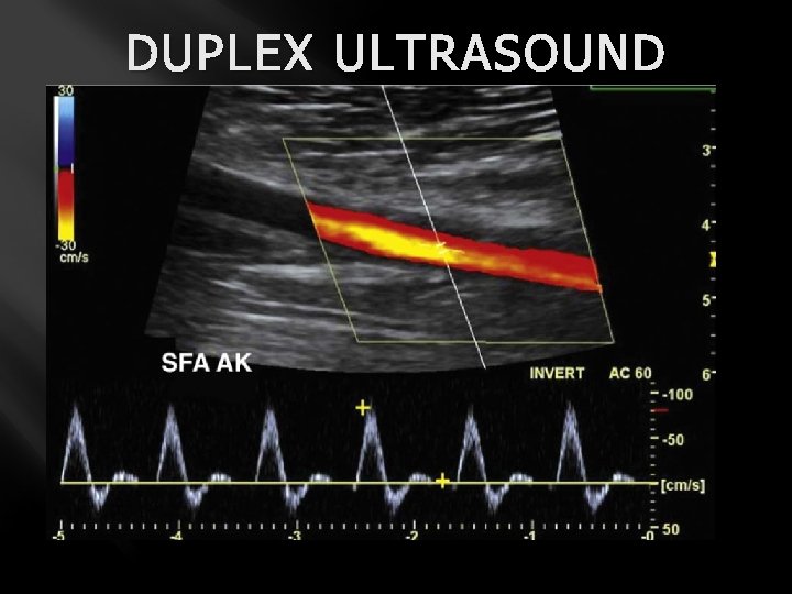 DUPLEX ULTRASOUND 