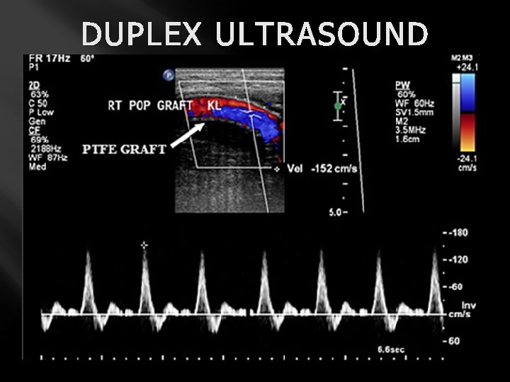 DUPLEX ULTRASOUND 