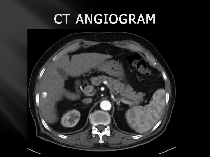 CT ANGIOGRAM 