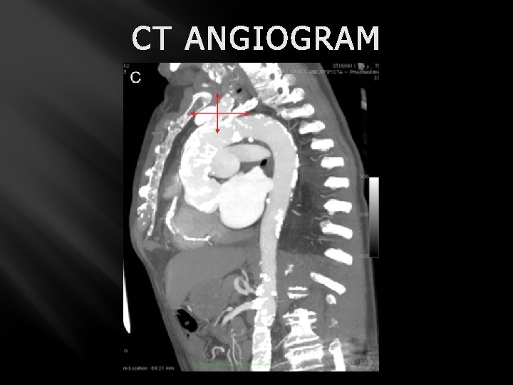 CT ANGIOGRAM 