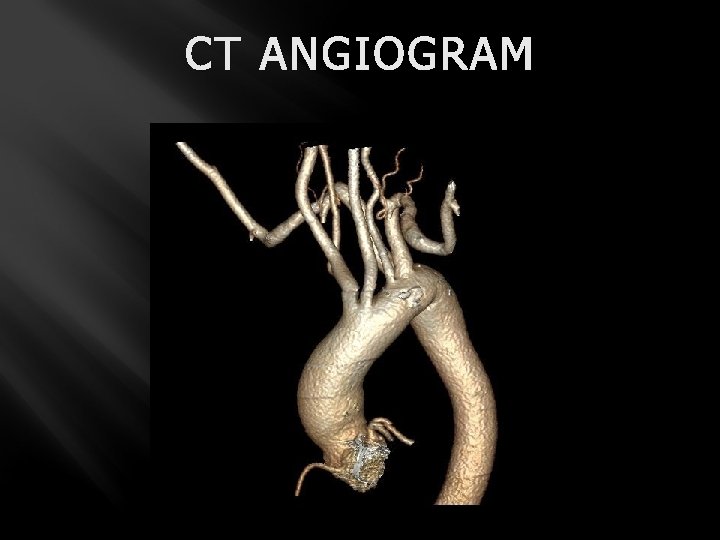 CT ANGIOGRAM 