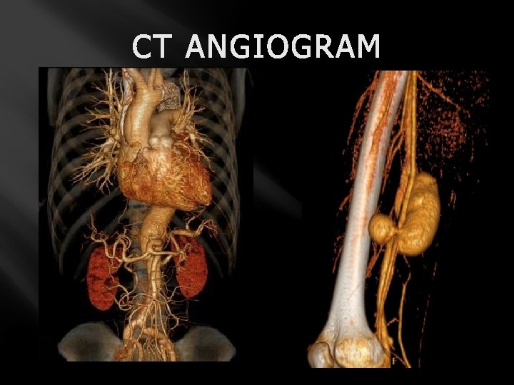 CT ANGIOGRAM 