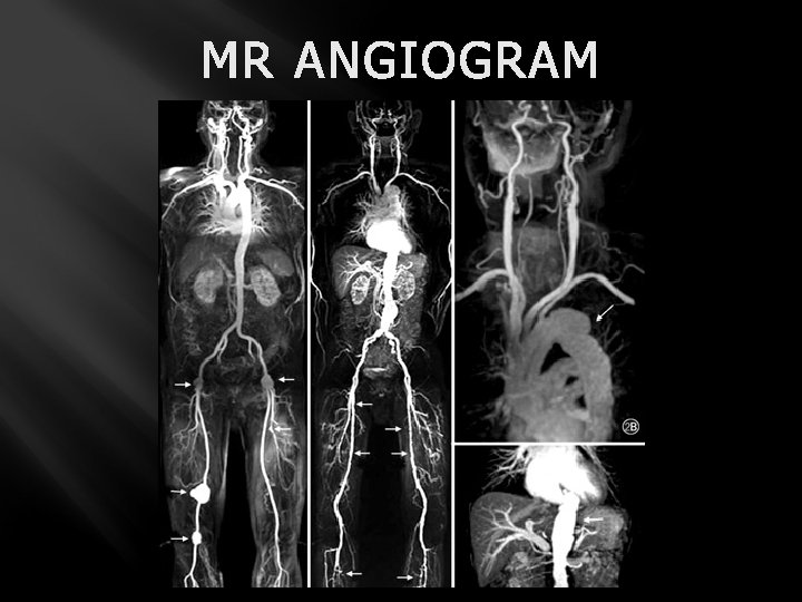 MR ANGIOGRAM 