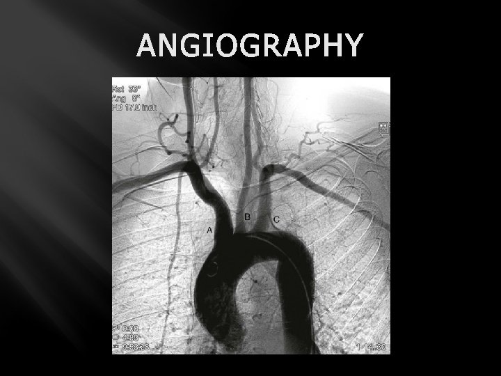 ANGIOGRAPHY 