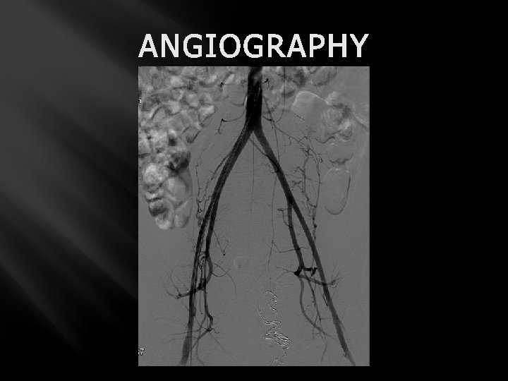 ANGIOGRAPHY 