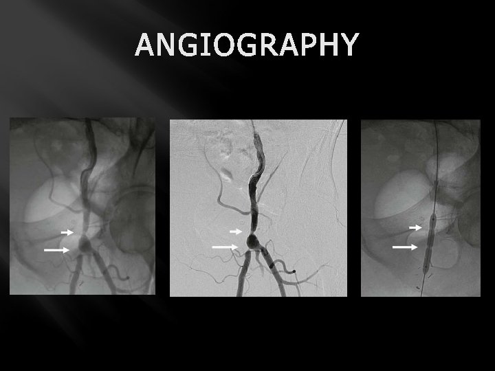 ANGIOGRAPHY 