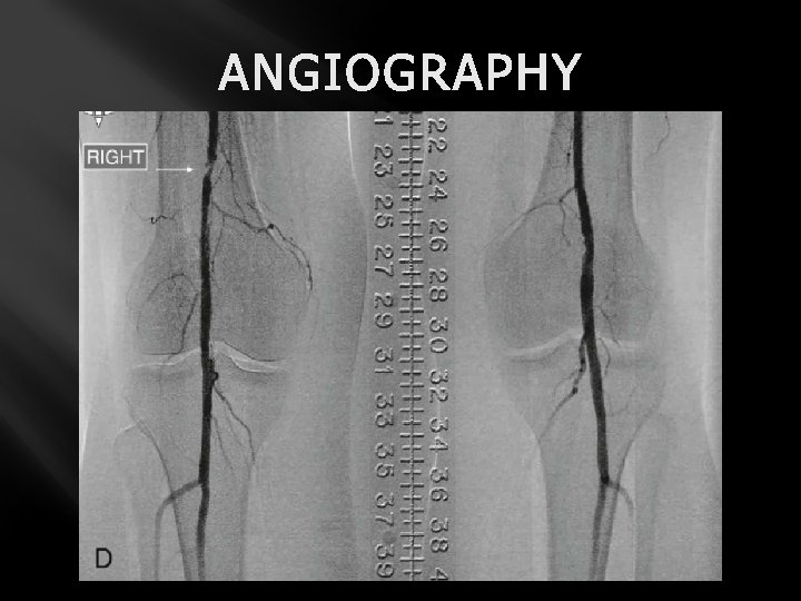 ANGIOGRAPHY 