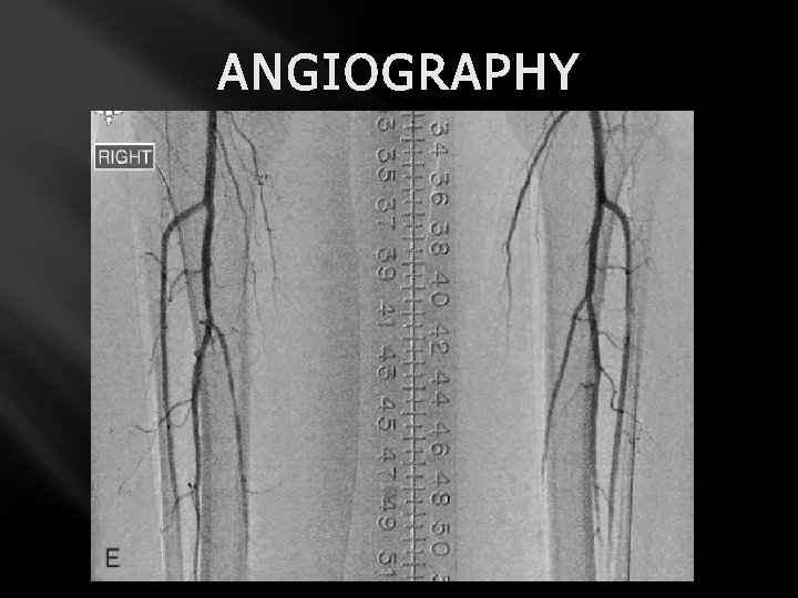 ANGIOGRAPHY 