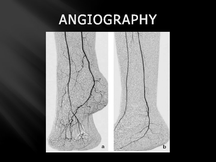 ANGIOGRAPHY 