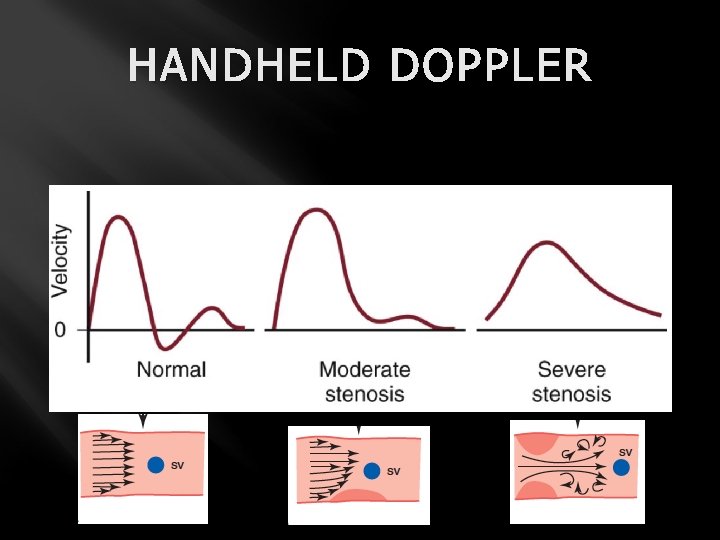 HANDHELD DOPPLER 