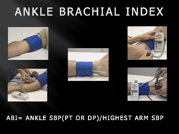 ANKLE BRACHIAL INDEX ABI= ANKLE SBP(PT OR DP)/HIGHEST ARM SBP 