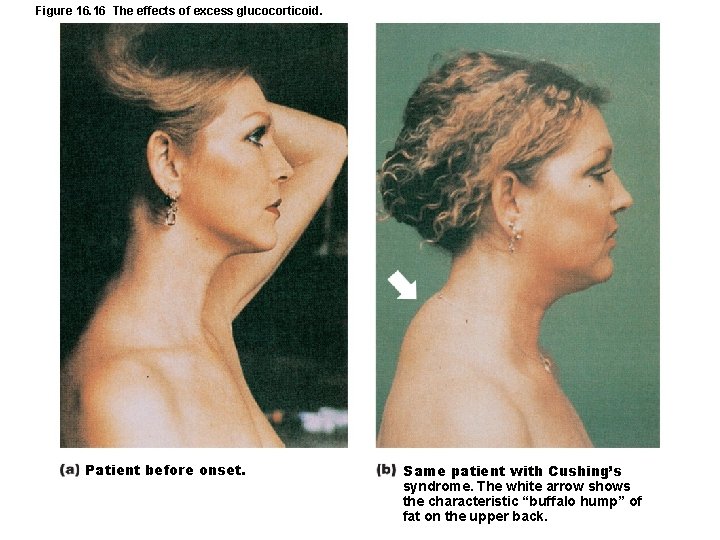 Figure 16. 16 The effects of excess glucocorticoid. Patient before onset. Same patient with