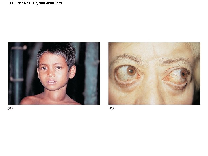 Figure 16. 11 Thyroid disorders. 