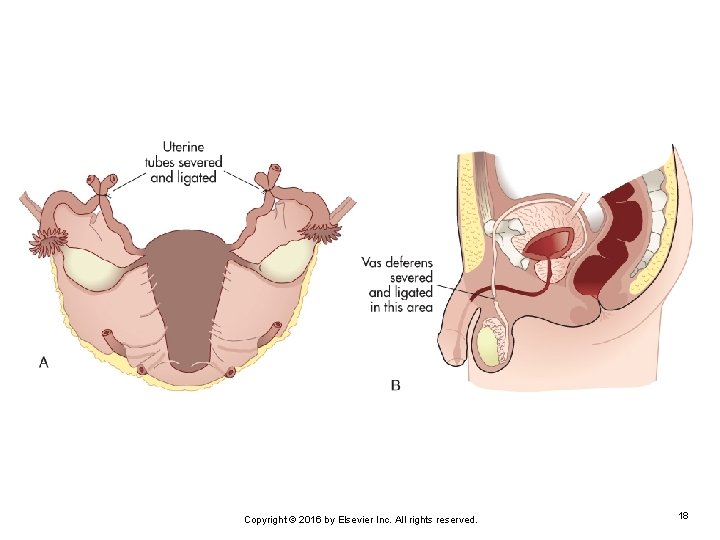 Copyright © 2016 by Elsevier Inc. All rights reserved. 18 