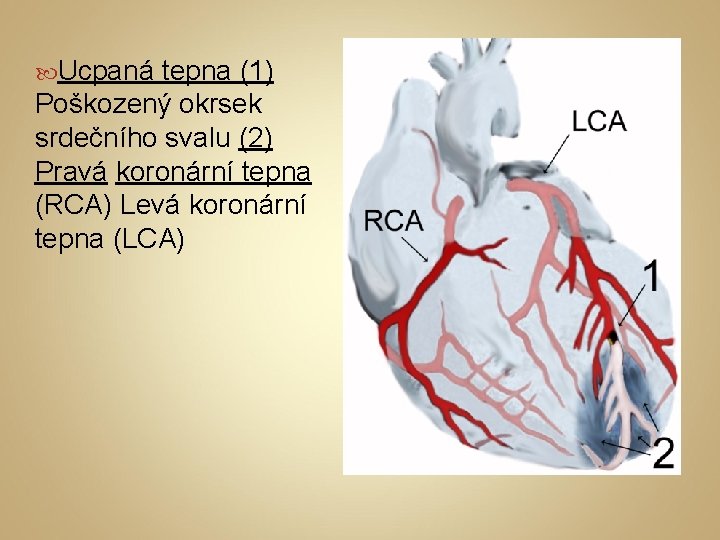  Ucpaná tepna (1) Poškozený okrsek srdečního svalu (2) Pravá koronární tepna (RCA) Levá