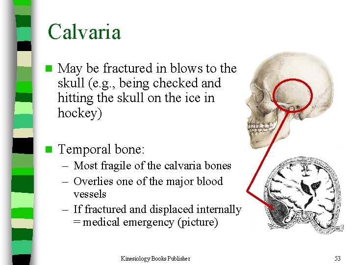 Calvaria n May be fractured in blows to the skull (e. g. , being