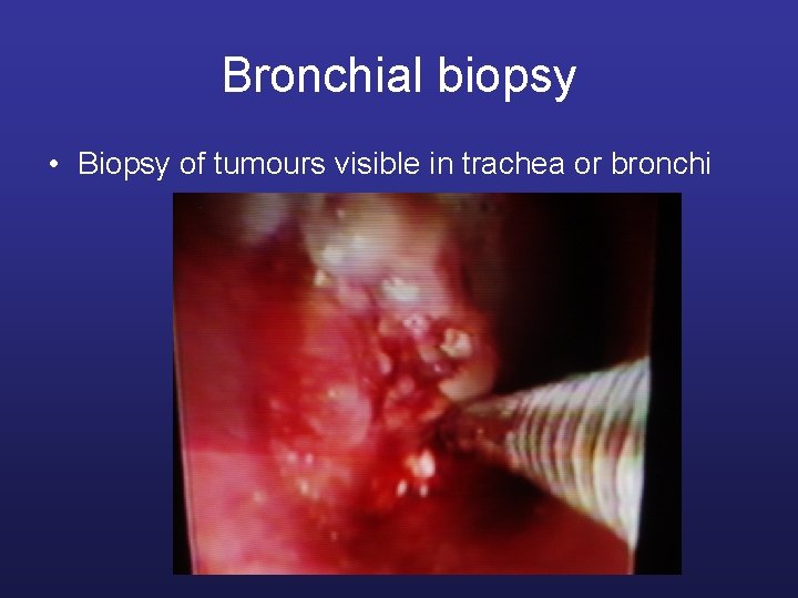 Bronchial biopsy • Biopsy of tumours visible in trachea or bronchi 