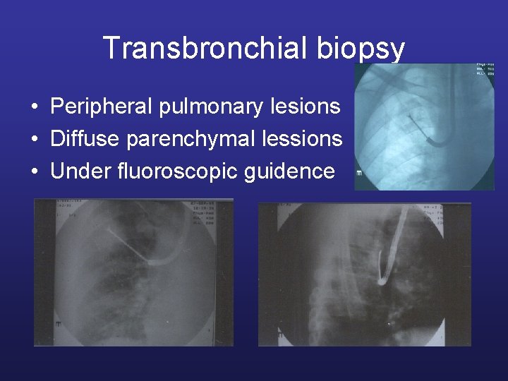 Transbronchial biopsy • Peripheral pulmonary lesions • Diffuse parenchymal lessions • Under fluoroscopic guidence
