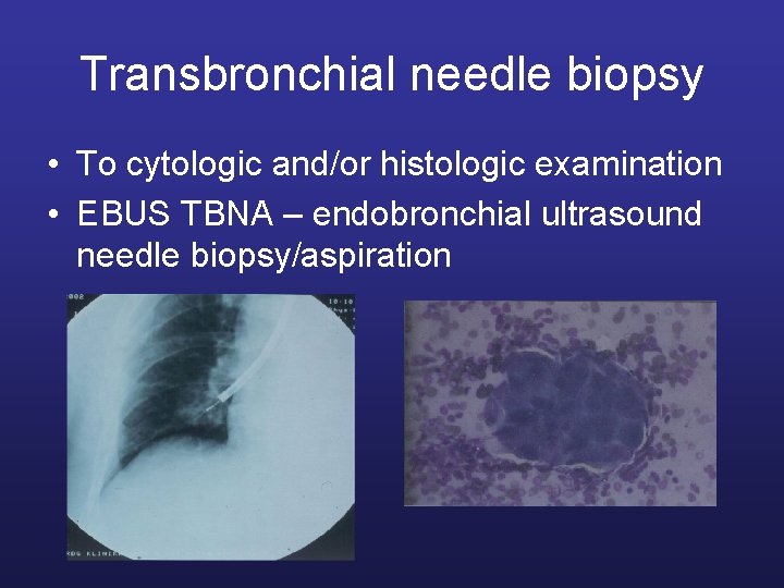 Transbronchial needle biopsy • To cytologic and/or histologic examination • EBUS TBNA – endobronchial