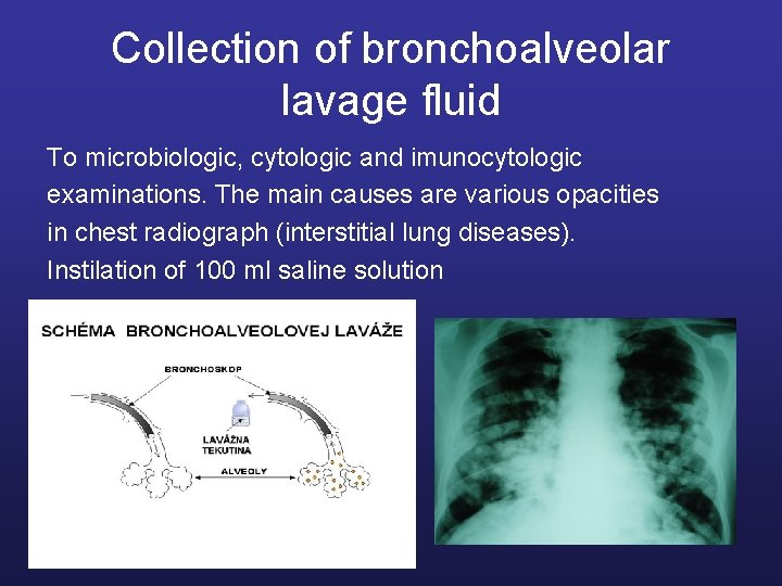 Collection of bronchoalveolar lavage fluid To microbiologic, cytologic and imunocytologic examinations. The main causes