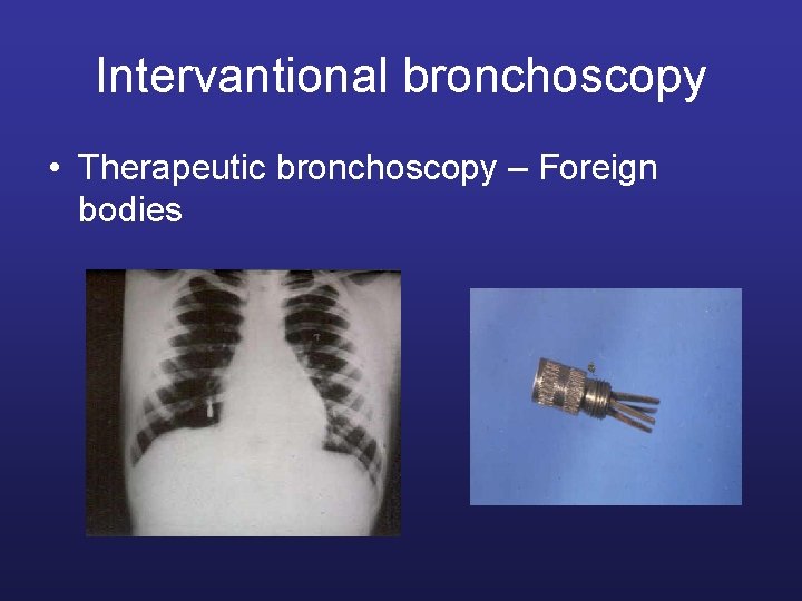 Intervantional bronchoscopy • Therapeutic bronchoscopy – Foreign bodies 
