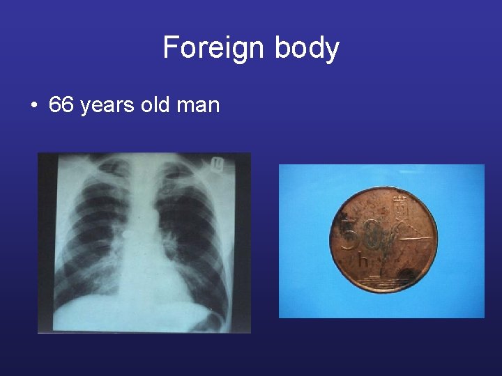 Foreign body • 66 years old man 
