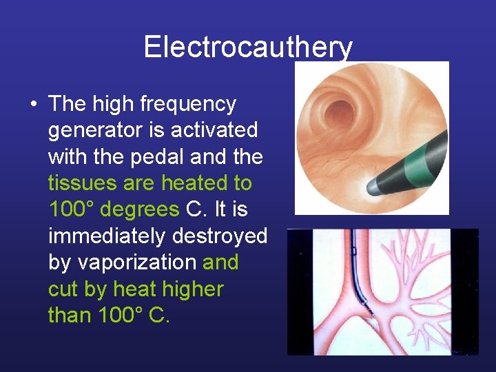 Electrocauthery • The high frequency generator is activated with the pedal and the tissues