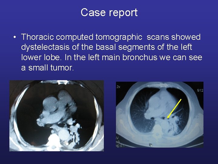 Case report • Thoracic computed tomographic scans showed dystelectasis of the basal segments of