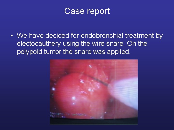 Case report • We have decided for endobronchial treatment by electocauthery using the wire