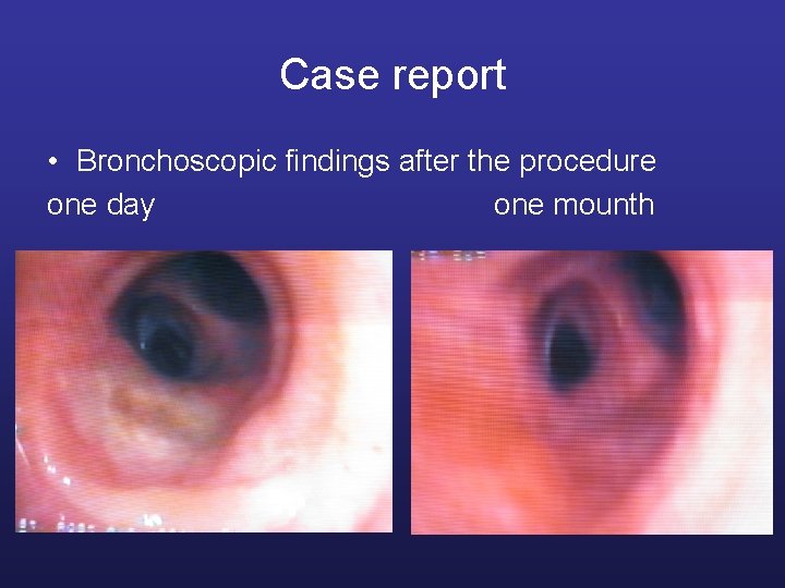 Case report • Bronchoscopic findings after the procedure one day one mounth 