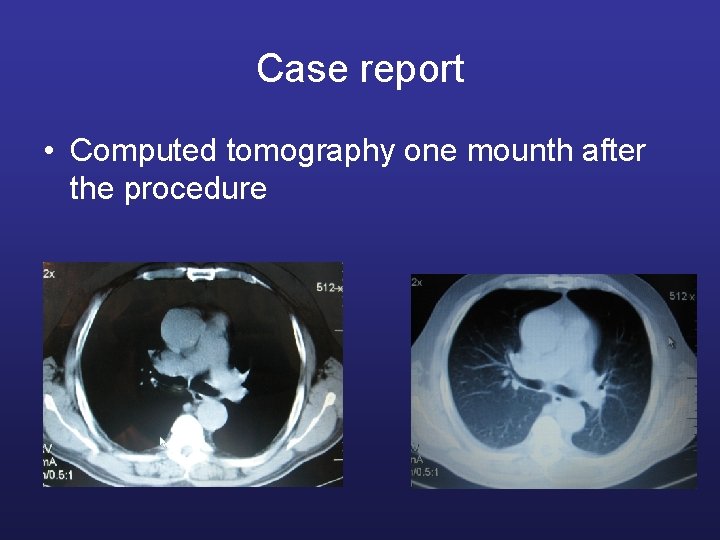 Case report • Computed tomography one mounth after the procedure 