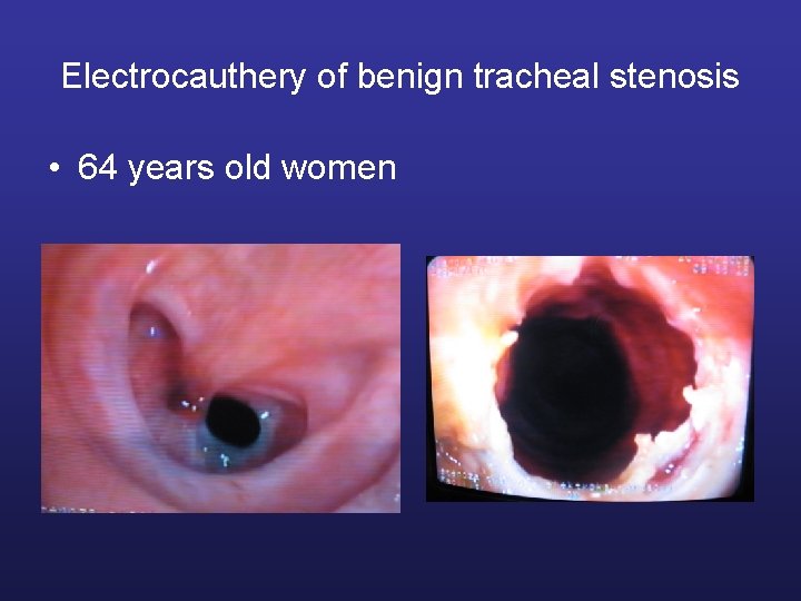 Electrocauthery of benign tracheal stenosis • 64 years old women 