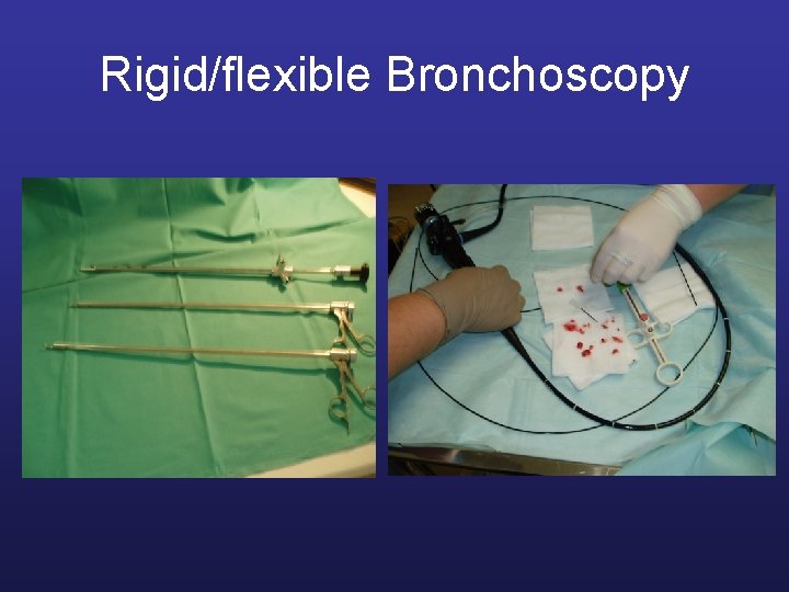 Rigid/flexible Bronchoscopy 