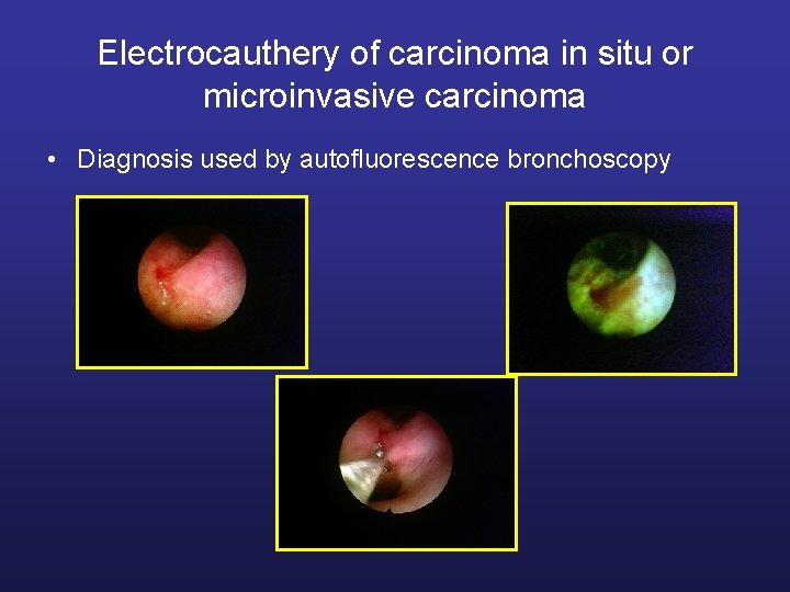 Electrocauthery of carcinoma in situ or microinvasive carcinoma • Diagnosis used by autofluorescence bronchoscopy