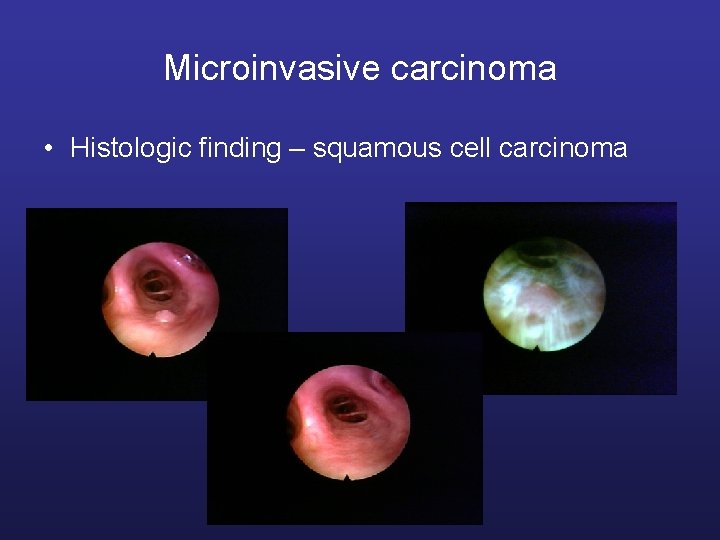 Microinvasive carcinoma • Histologic finding – squamous cell carcinoma 