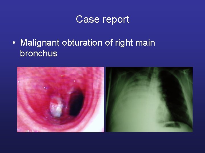 Case report • Malignant obturation of right main bronchus 