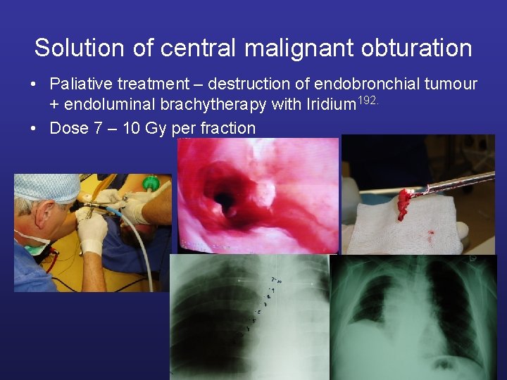 Solution of central malignant obturation • Paliative treatment – destruction of endobronchial tumour +