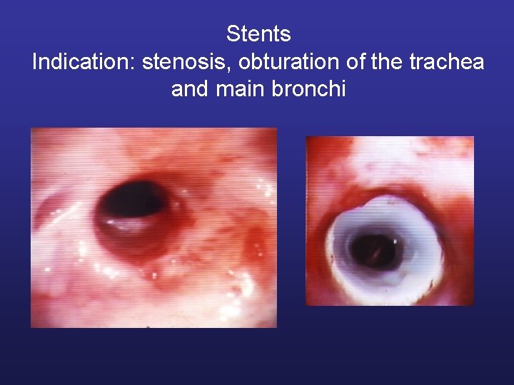 Stents Indication: stenosis, obturation of the trachea and main bronchi 