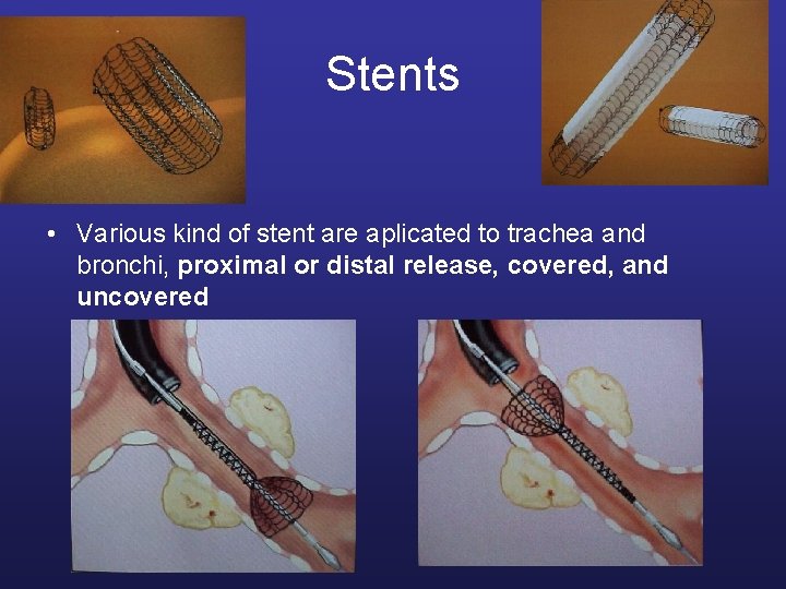 Stents • Various kind of stent are aplicated to trachea and bronchi, proximal or