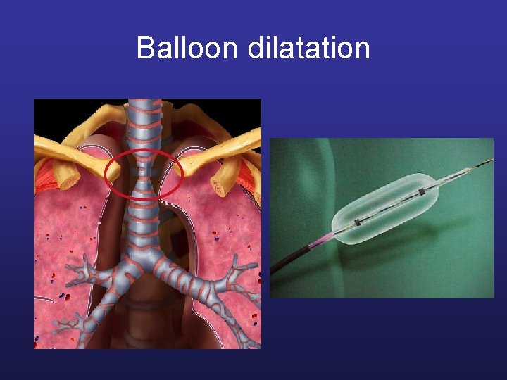 Balloon dilatation 