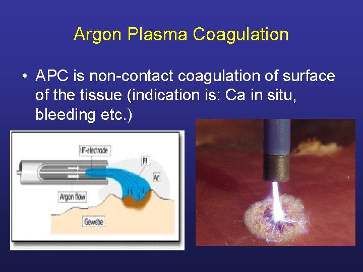 Argon Plasma Coagulation • APC is non-contact coagulation of surface of the tissue (indication