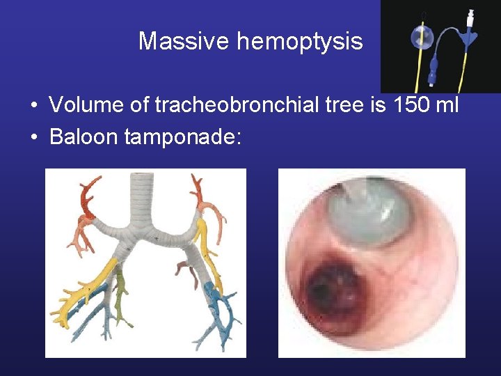 Massive hemoptysis • Volume of tracheobronchial tree is 150 ml • Baloon tamponade: 