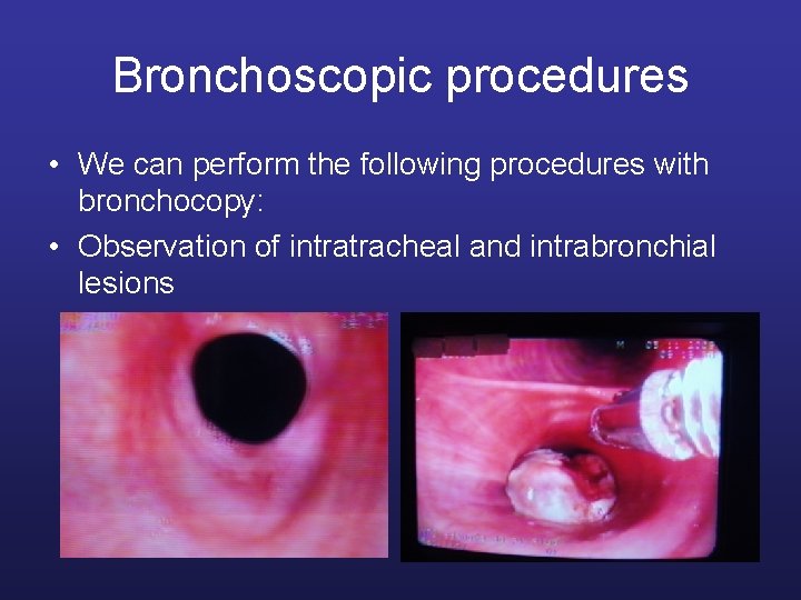 Bronchoscopic procedures • We can perform the following procedures with bronchocopy: • Observation of