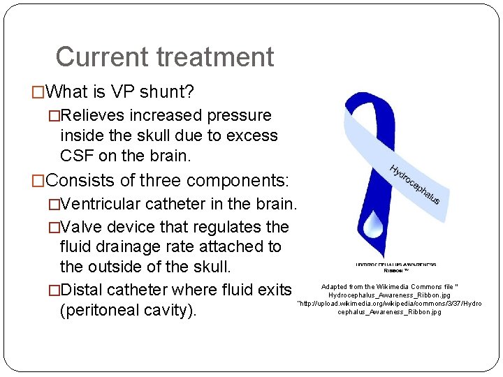 Current treatment �What is VP shunt? �Relieves increased pressure inside the skull due to