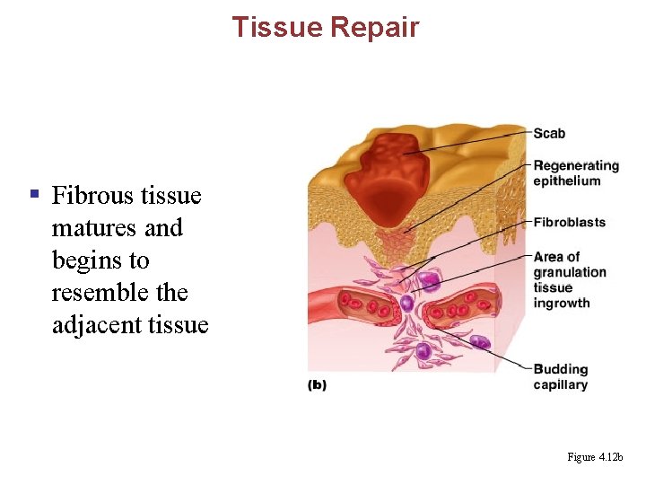Tissue Repair § Fibrous tissue matures and begins to resemble the adjacent tissue Figure